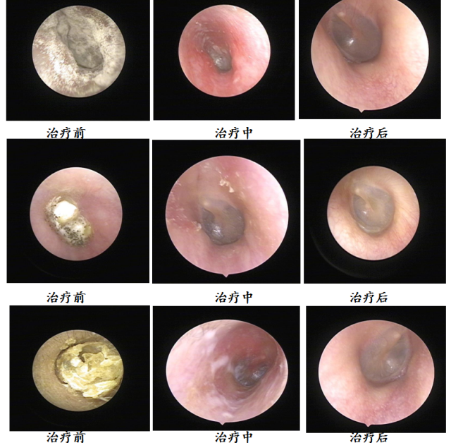 耳內(nèi)鏡下真菌治療效果對比展示.png